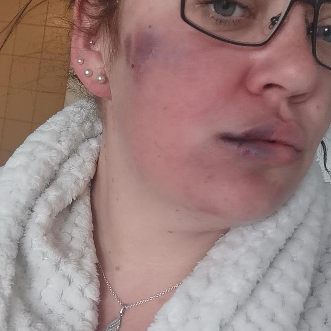 Angelica Svensson blev misshandlad på doktorspromenaden under onsdagskvällen i förra veckan. 