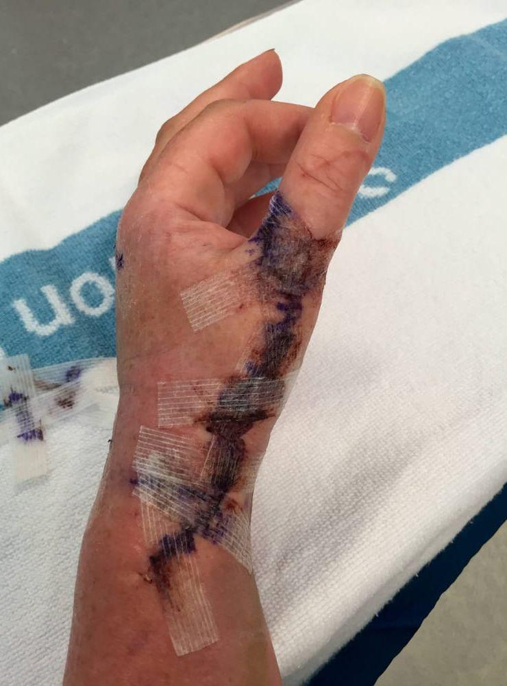 Tumsenan på Camilla Benons vänsterhand skars av under en operation och när den skulle återskapas försämrades även hennes pekfinger. Före sommaren ska en fjärde operation göras. Bild: Privat
