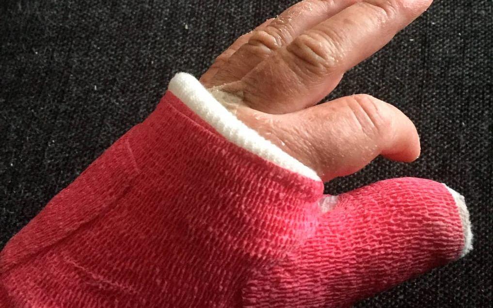 Före sommaren ska en fjärde operation göras och Camilla Benon hoppas att hennes hand äntligen ska bli bättre. Bild: Privat
