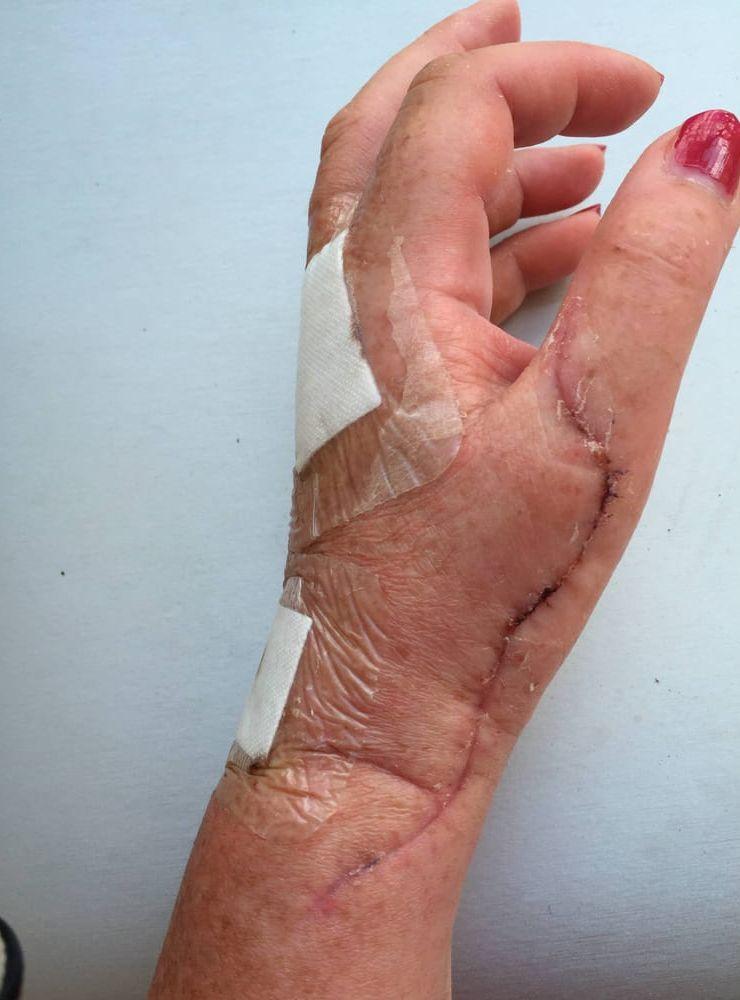 Tumsenan på Camilla Benons vänsterhand skars av under en operation och när den skulle återskapas försämrades även hennes pekfinger. Bild: Privat
